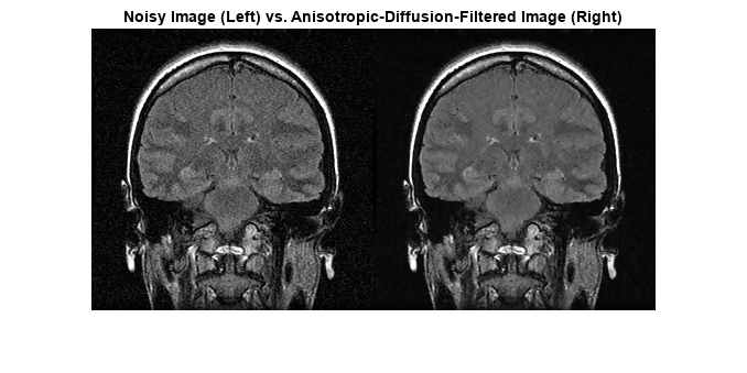 图包含一个坐标轴对象。坐标轴对象标题嘈杂的图像(左)与Anisotropic-Diffusion-Filtered图像(右)包含一个类型的对象的形象。