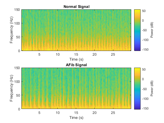 Classify ECG Signals Using Long Short-Term Memory Networks